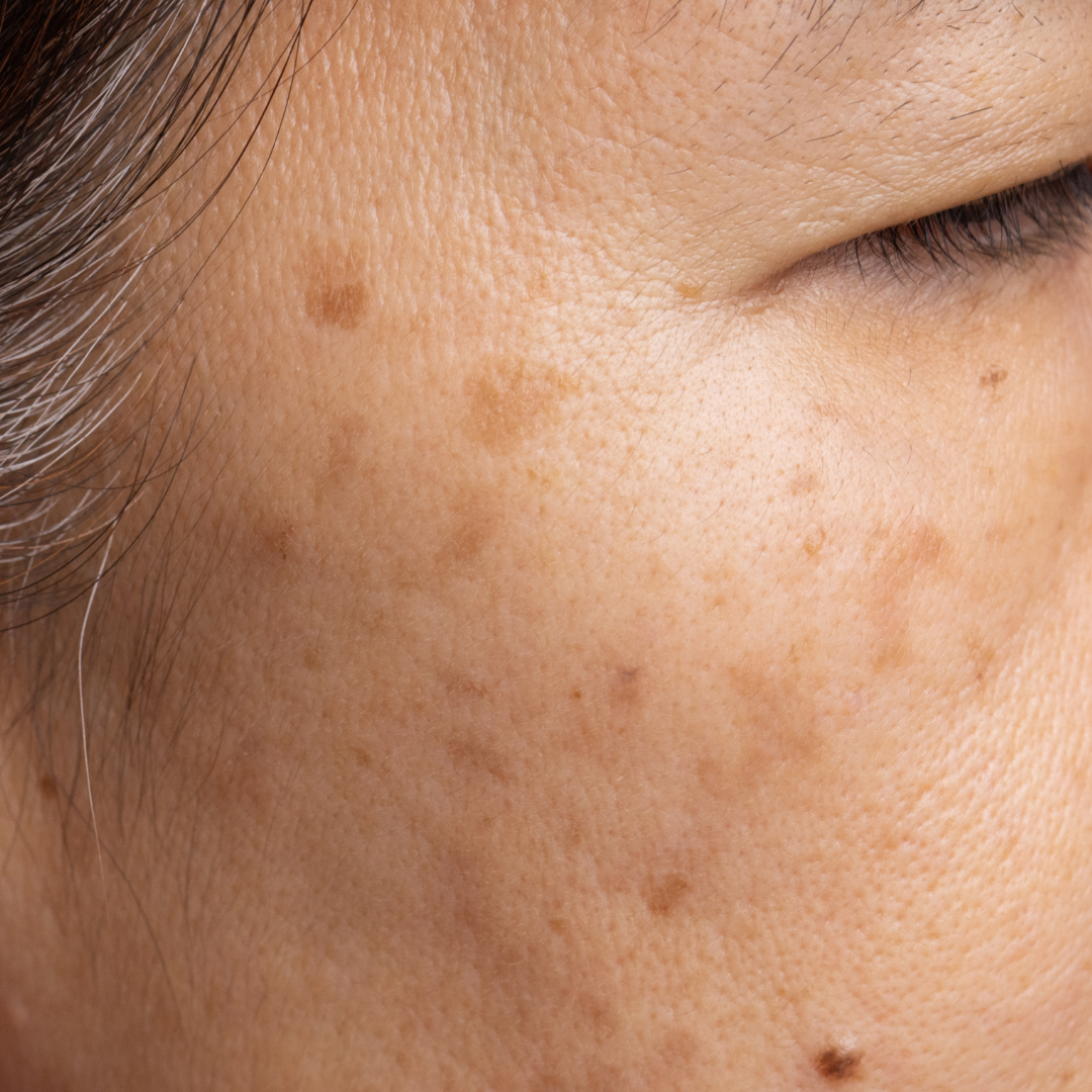 Understanding Melasma During Pregnancy: Causes, Prevention, and Treatment