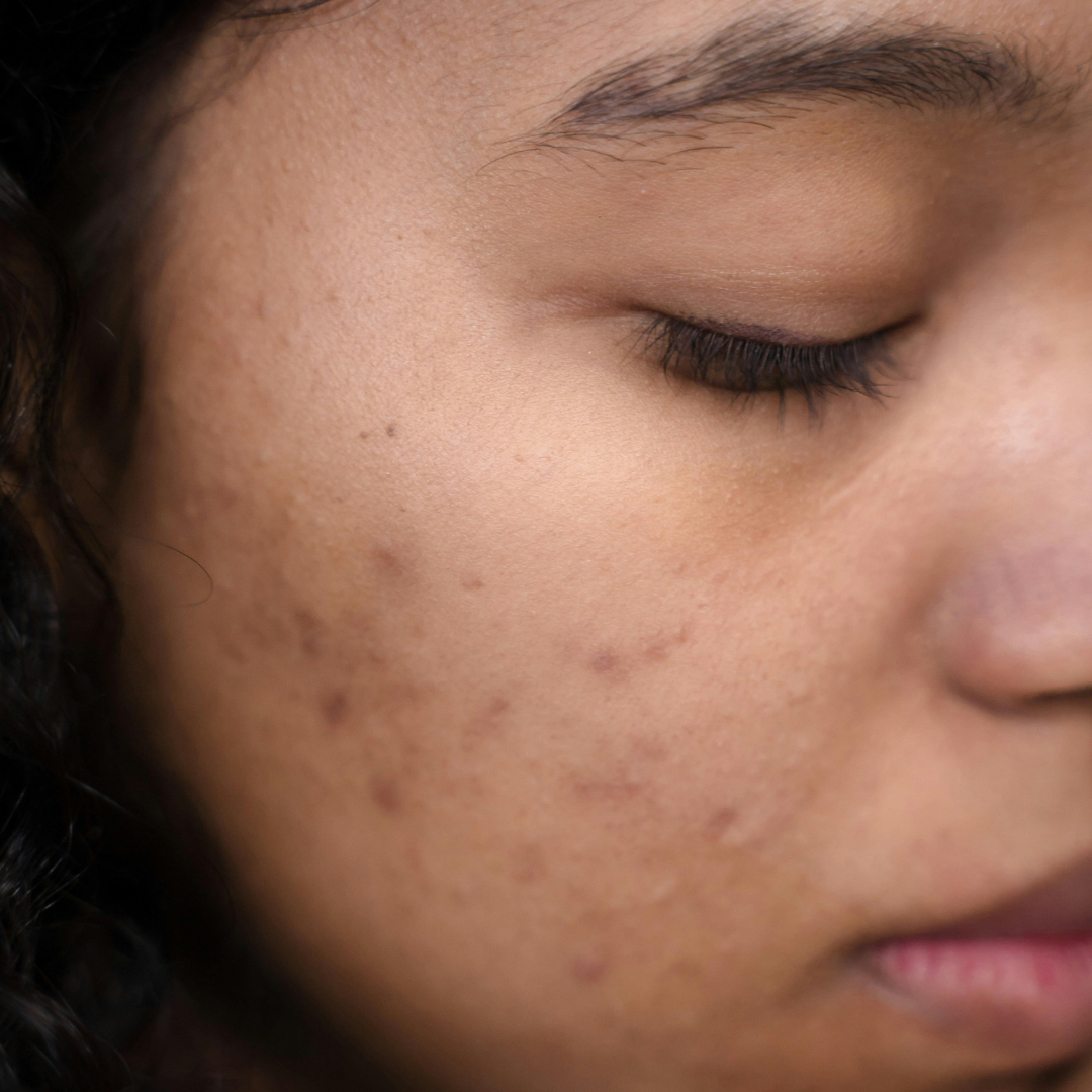 How Hyperpigmentation Affects Self-Esteem and Confidence